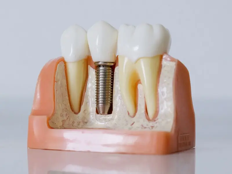 Detalle de Implantes en Planident